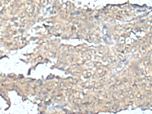 Immunohistochemistry of paraffin-embedded Human ovarian cancer tissue using MEF2D Polyclonal Antibody at dilution of 1:50(×200)
