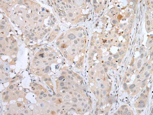 Immunohistochemistry of paraffin-embedded Human esophagus cancer tissue using BORCS8 Polyclonal Antibody at dilution of 1:50(×200)