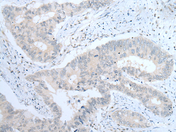 Immunohistochemistry of paraffin-embedded Human colorectal cancer tissue using ITGA8 Polyclonal Antibody at dilution of 1:30(×200)