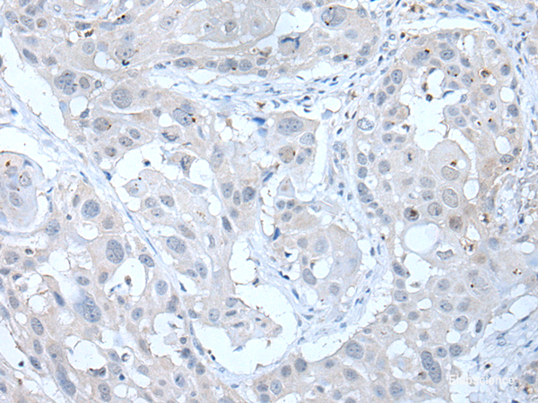 Immunohistochemistry of paraffin-embedded Human esophagus cancer tissue using ANGPTL6 Polyclonal Antibody at dilution of 1:55(×200)