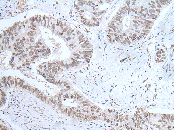 Immunohistochemistry of paraffin-embedded Human colorectal cancer tissue using HCRT Polyclonal Antibody at dilution of 1:25(×200)
