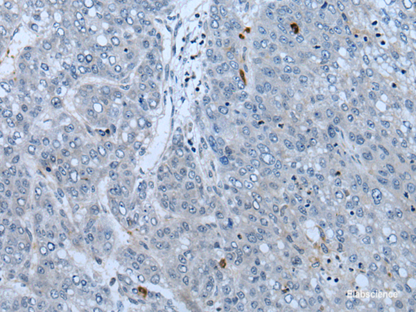 Immunohistochemistry of paraffin-embedded Human liver cancer tissue using NF1 Polyclonal Antibody at dilution of 1:65(×200)