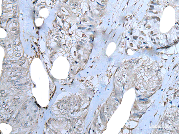 Immunohistochemistry of paraffin-embedded Human colorectal cancer tissue using ZNF703 Polyclonal Antibody at dilution of 1:40(×200)