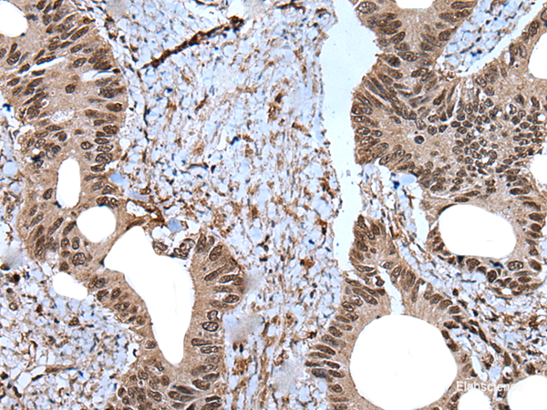 Immunohistochemistry of paraffin-embedded Human colorectal cancer tissue using ZNF787 Polyclonal Antibody at dilution of 1:45(×200)