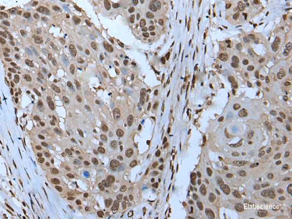 Immunohistochemistry of paraffin-embedded Human esophagus cancer tissue using ZNHIT3 Polyclonal Antibody at dilution of 1:95(×200)