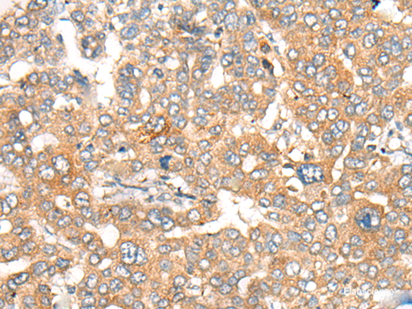 Immunohistochemistry of paraffin-embedded Human liver cancer tissue using CASP4 Polyclonal Antibody at dilution of 1:40(×200)