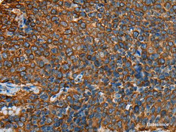 Immunohistochemistry of paraffin-embedded Human cervical cancer tissue using YBX1 Polyclonal Antibody at dilution of 1:25(×200)