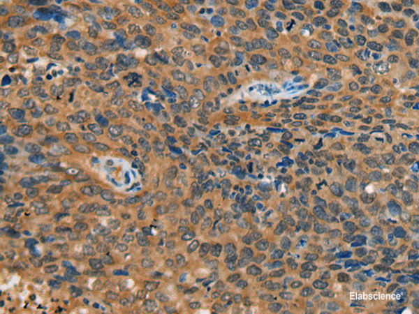 Immunohistochemistry of paraffin-embedded Human cervical cancer tissue using YTHDF1 Polyclonal Antibody at dilution of 1:55(×200)