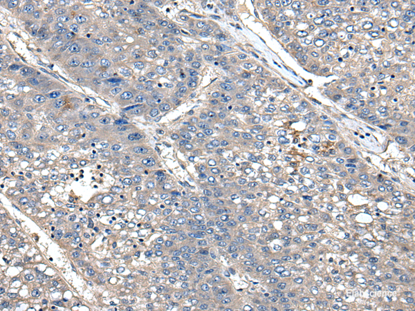 Immunohistochemistry of paraffin-embedded Human liver cancer tissue using XDH Polyclonal Antibody at dilution of 1:85(×200)