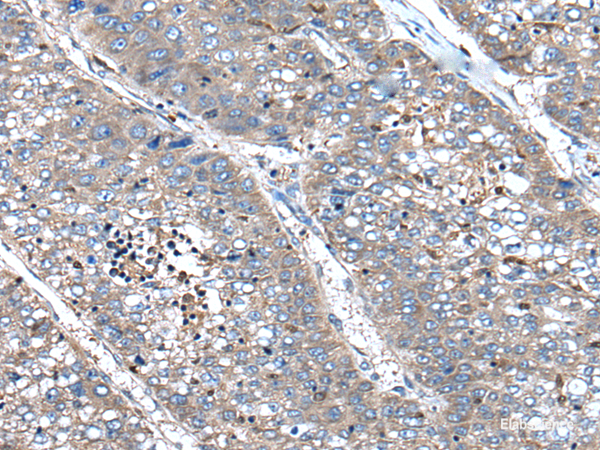 Immunohistochemistry of paraffin-embedded Human liver cancer tissue using XIRP1 Polyclonal Antibody at dilution of 1:90(×200)