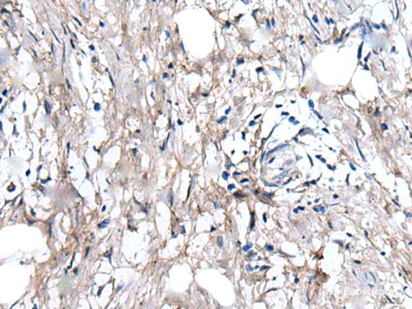 Immunohistochemistry of paraffin-embedded Human gastric cancer tissue using WRN Polyclonal Antibody at dilution of 1:55(×200)