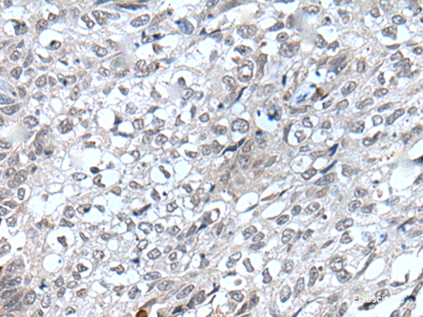 Immunohistochemistry of paraffin-embedded Human lung cancer tissue using FLT4 Polyclonal Antibody at dilution of 1:40(×200)