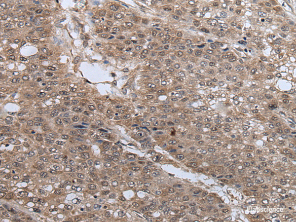 Immunohistochemistry of paraffin-embedded Human liver cancer tissue using UBE4B Polyclonal Antibody at dilution of 1:40(×200)