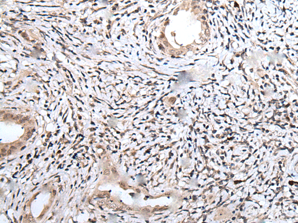 Immunohistochemistry of paraffin-embedded Human cervical cancer tissue using UBN1 Polyclonal Antibody at dilution of 1:75(×200)