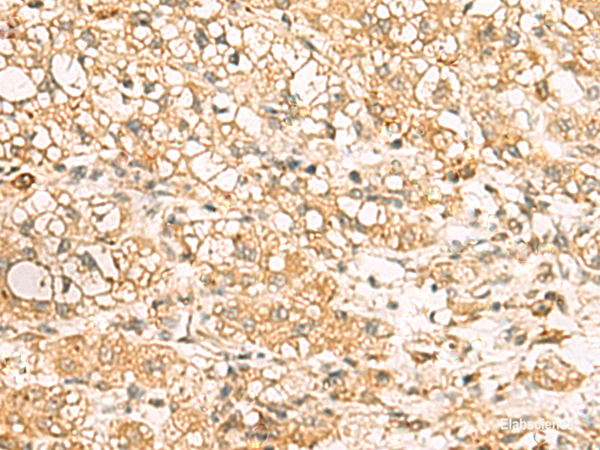 Immunohistochemistry of paraffin-embedded Human liver cancer tissue using USP24 Polyclonal Antibody at dilution of 1:35(×200)