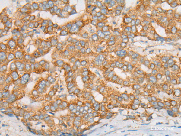 Immunohistochemistry of paraffin-embedded Human liver cancer tissue using ATXN7 Polyclonal Antibody at dilution of 1:60(×200)