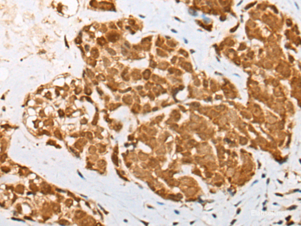 Immunohistochemistry of paraffin-embedded Human thyroid cancer tissue using ATN1 Polyclonal Antibody at dilution of 1:50(×200)