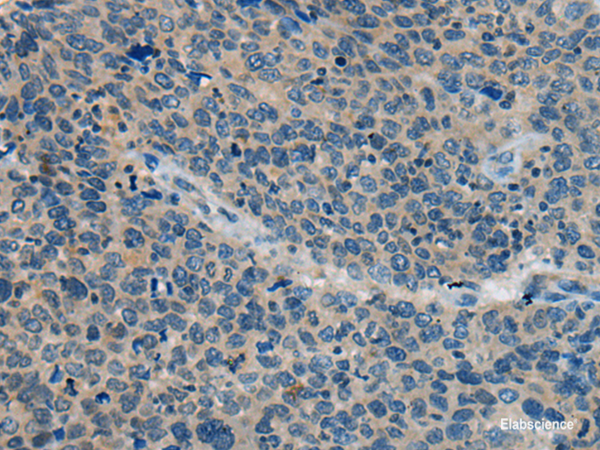 Immunohistochemistry of paraffin-embedded Human cervical cancer tissue using BACE2 Polyclonal Antibody at dilution of 1:45(×200)