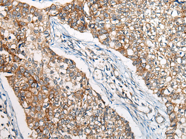 Immunohistochemistry of paraffin-embedded Human lung cancer tissue using BBS12 Polyclonal Antibody at dilution of 1:50(×200)