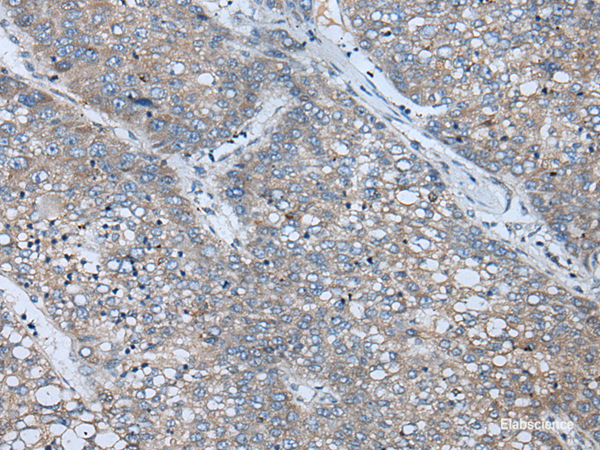 Immunohistochemistry of paraffin-embedded Human liver cancer tissue using BICD2 Polyclonal Antibody at dilution of 1:70(×200)