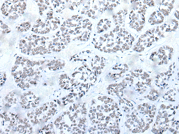 Immunohistochemistry of paraffin-embedded Human esophagus cancer tissue using BRD3 Polyclonal Antibody at dilution of 1:60(×200)