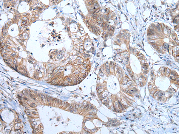 Immunohistochemistry of paraffin-embedded Human colorectal cancer tissue using PRSS50 Polyclonal Antibody at dilution of 1:65(×200)