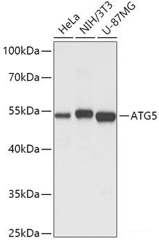 Immunohistochemistry of paraffin-embedded Human lung cancer using TEK Polyclonal Antibody at dilution of 1:100 (40x lens).