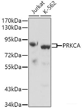 Immunohistochemistry of paraffin-embedded Human liver cancer using RAP1A Polyclonal Antibody at dilution of 1:100 (40x lens).