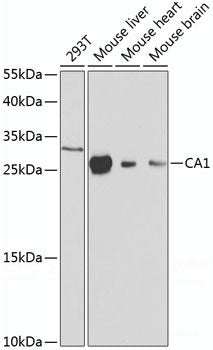 Immunohistochemistry of paraffin-embedded Human mammary cancer using AKT Polyclonal Antibody at dilution of 1:100 (40x lens).
