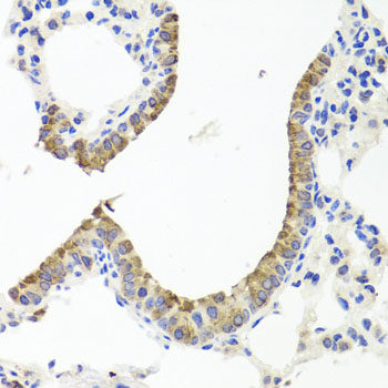 Immunohistochemistry of paraffin-embedded Human lung cancer using SRC Polyclonal Antibody at dilution of 1:100 (40x lens).