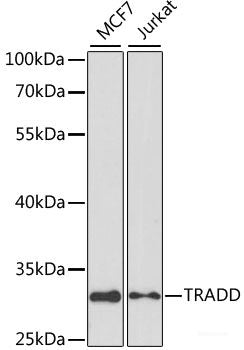 Immunohistochemistry of paraffin-embedded Human mammary cancer using Caspase-3 Polyclonal Antibody at dilution of 1:200 (40x lens).