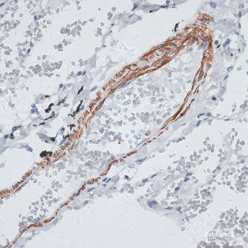 Immunohistochemistry of paraffin-embedded Human lung cancer using TrkB Polyclonal Antibody at dilution of 1:200 (40x lens).