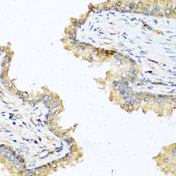 Immunohistochemistry of paraffin-embedded Human lung cancer using PRSS1 Polyclonal Antibody at dilution of 1:100 (40x lens).