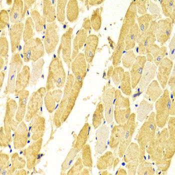 Immunohistochemistry of paraffin-embedded Human mammary cancer using NOD1 Polyclonal Antibody at dilution of 1:100 (40x lens).