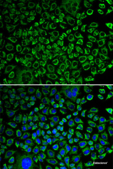 Immunohistochemistry of paraffin-embedded Human thyroid cancer using S100A5 Polyclonal Antibody at dilution of 1:100 (40x lens).