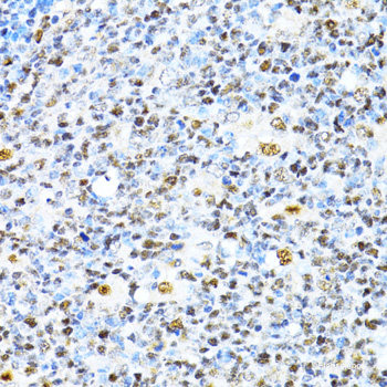 Immunohistochemistry of paraffin-embedded Human lung cancer using NCSTN Polyclonal Antibody at dilution of 1:100 (40x lens).