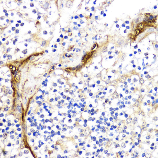 Immunohistochemistry of paraffin-embedded Human lung cancer using EIF4E Polyclonal Antibody at dilution of 1:100 (40x lens).