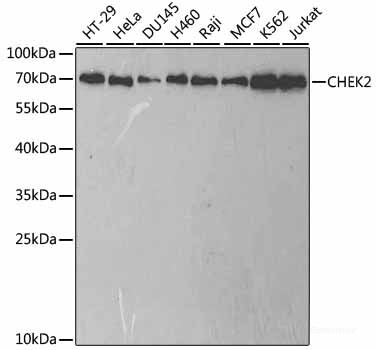 Immunohistochemistry of paraffin-embedded Human esophageal cancer using c-Fos Polyclonal Antibody at dilution of 1:100 (40x lens).