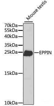 Immunohistochemistry of paraffin-embedded Human mammary cancer using WNT1 Polyclonal Antibody at dilution of 1:100 (40x lens).