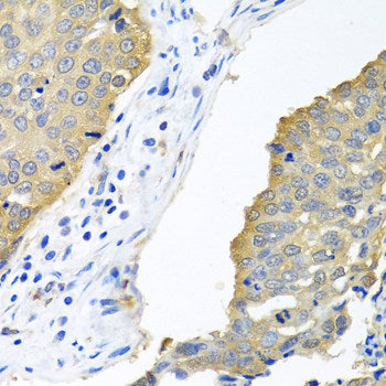 Immunohistochemistry of paraffin-embedded Human colon carcinoma using LYZ Polyclonal Antibody at dilution of 1:100 (40x lens).