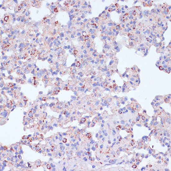 Immunohistochemistry of paraffin-embedded Human lung cancer using TIM-3/HAVCR2 Polyclonal Antibody at dilution of 1:200 (40x lens).