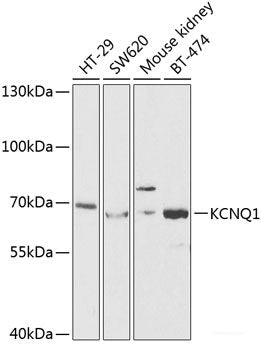 Immunohistochemistry of paraffin-embedded Human stomach cancer using GYS1 Polyclonal Antibody at dilution of 1:200 (40x lens).