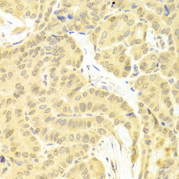 Western blot analysis of extracts of Human stomach cancer tissue using CCKBR Polyclonal Antibody.