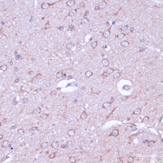 Immunohistochemistry of paraffin-embedded Human liver cancer using STAT3 Polyclonal Antibody at dilution of 1:100 (40x lens).