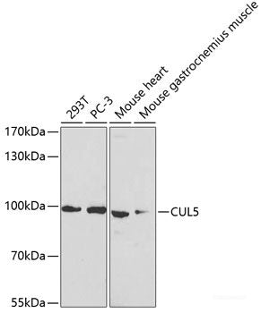 Immunohistochemistry of paraffin-embedded Human liver cancer using WNK3 Polyclonal Antibody at dilution of 1:100 (40x lens).
