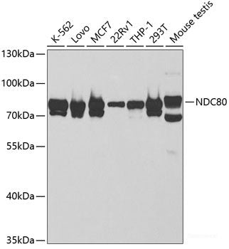 Immunohistochemistry of paraffin-embedded Human mammary cancer using CREM Polyclonal Antibody at dilution of 1:100 (40x lens).