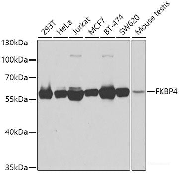 Immunohistochemistry of paraffin-embedded Human esophageal cancer using PRKCQ Polyclonal Antibody at dilution of 1:200 (40x lens).
