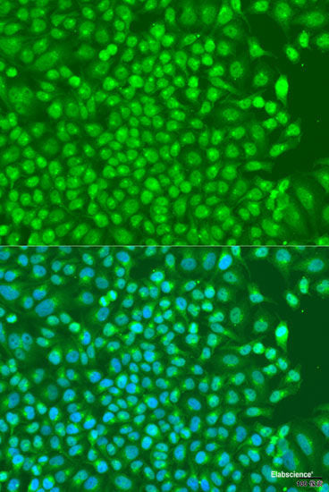 Immunohistochemistry of paraffin-embedded Human adenomyosis using PHC1 Polyclonal Antibody at dilution of 1:200 (40x lens).