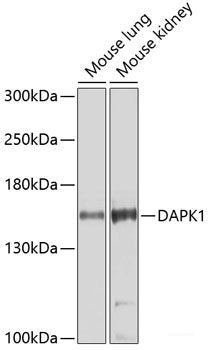 Immunohistochemistry of paraffin-embedded Human lung cancer using HTATSF1 Polyclonal Antibody at dilution of 1:100 (40x lens).