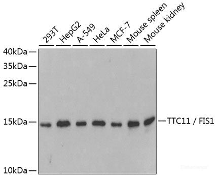 Immunohistochemistry of paraffin-embedded Human liver cancer using PIGR Polyclonal Antibody at dilution of 1:100 (40x lens).